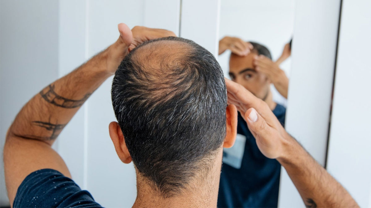 টাক হওয়ার ঝুঁকি বাড়ায় যে ৪ খাবার